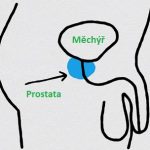 Rakovina prostaty – příčina, projevy a léčba (i bylinkami)