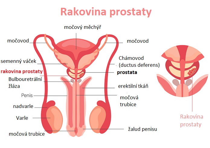 Rakovina prostaty - ilustrace