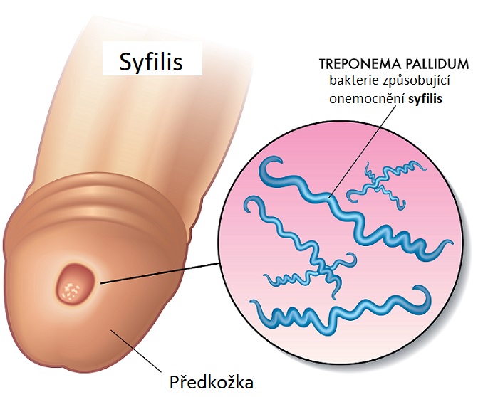 Syfilis - ilustrace