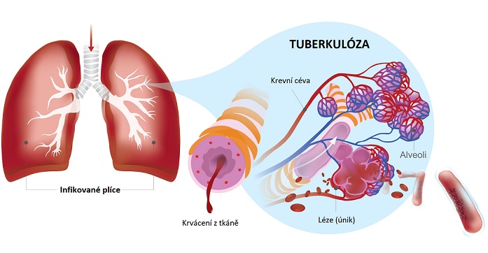 Tuberkulóza - ilustrace