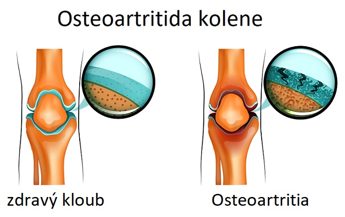 Osteoartritida - ilustrace
