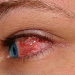 Červené oči – jak na ně a co mohou znamenat?