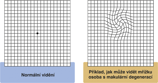 amslerova-mrizka-priklady