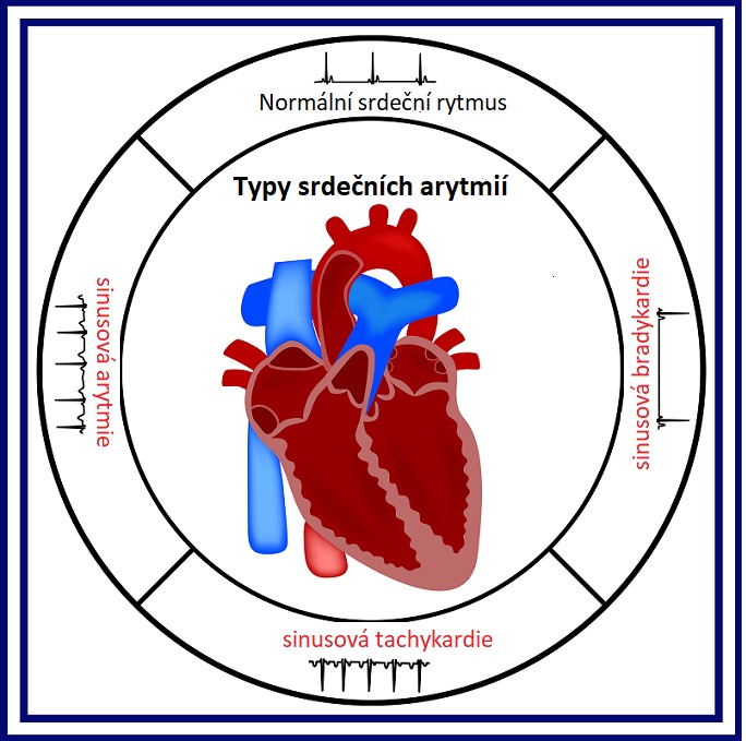 Srdeční arytmie - ilustrace