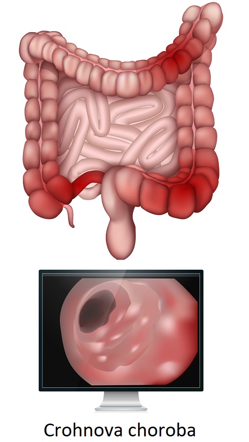 Crohnova choroba - ilustrace