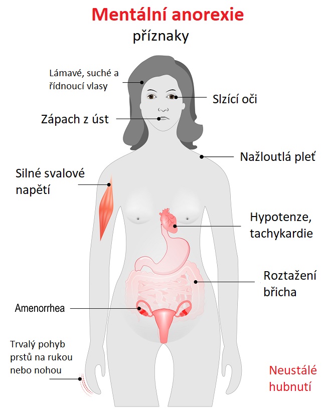 Mentální anorexie - ilustrace