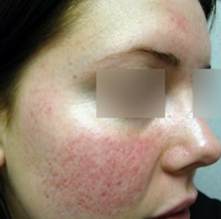 rosacea-zarudnuti