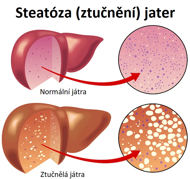 Steatóza (ztučnění) jater - ilustrace