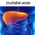 Steatóza (ztučnění) jater – příčiny, příznaky, léčba i jídelníček