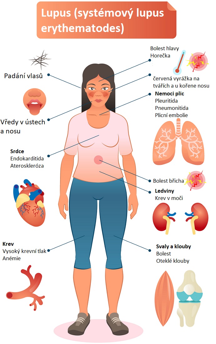 Lupus (systémový lupus erythematodes) a jeho příznaky