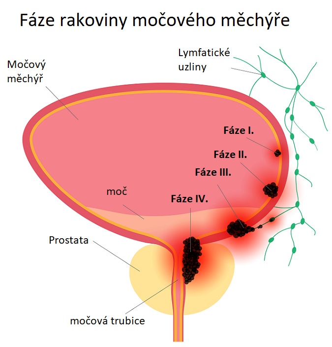 Rakovina močového měchýře a její fáze - ilustrace