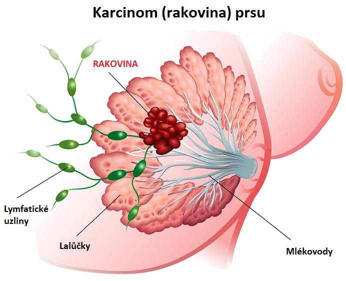 Rakovina prsu - ilustrace