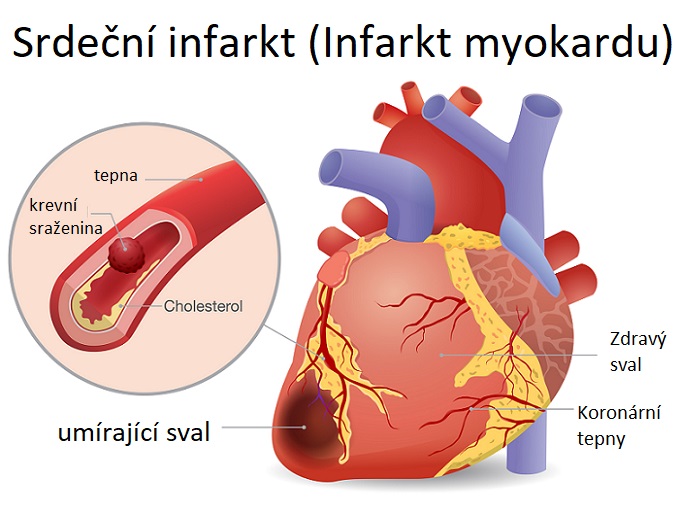 Srdeční infarkt (Infarkt myokardu) - ilustrace