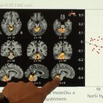 Parkinsonova choroba – příznaky této nemoci a možnosti její léčby