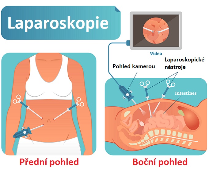 Laparoskopie - ilustrace
