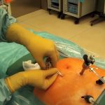 Laparoskopie či laparoskopická operace – jaké má výhody?