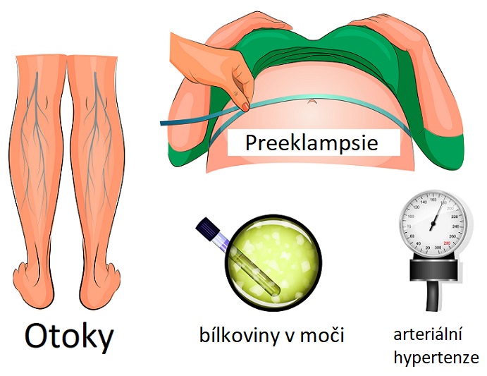 Preeklampsie je komplikace během těhotenství, která se obvykle vyskytuje po 20. týdnu těhotenství a charakterizuje se zvýšeným krevním tlakem (hypertenze) a přítomností bílkoviny v moči (proteinurie). 