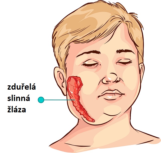 Příušnice (parotitis epidemica, parotitida) jsou akutní, vysoce nakažlivé onemocnění s typickým otokem a zduřením slinných žláz.