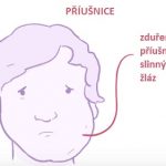 Příušnice a vše o nich – příznaky, přenos a léčba