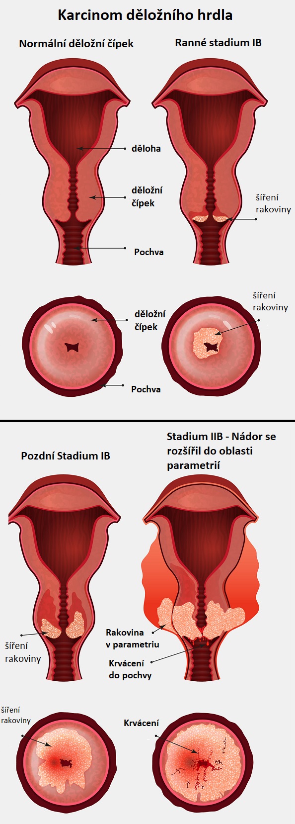 Rakovina děložního čípku - ilustrace
