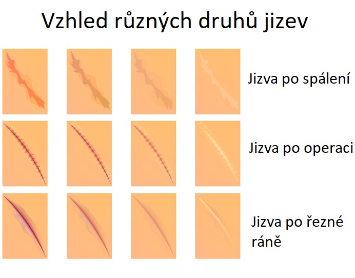 Různé druhy jizev