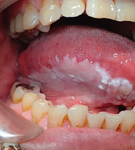 Leukoplakie - foto