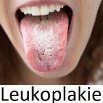 Leukoplakie – bílý povlak či skvrny na sliznicích – příznaky, příčiny a léčba