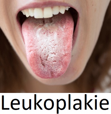 Leukoplakie - bílý povlak či skvrny na sliznicích