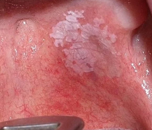 Leukoplakie