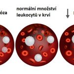 Leukocytóza – zvýšený počet bílých krvinek – příznaky, příčiny a léčba