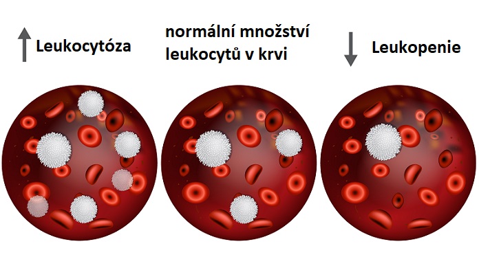 Leukopenie & leukocytóza - ilustrace