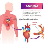Jak se léčí angina pectoris?