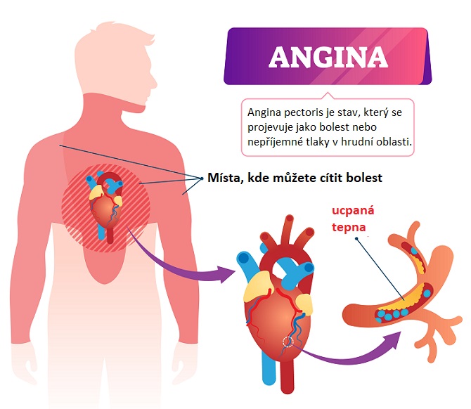 Kde bolí angina pectoris?