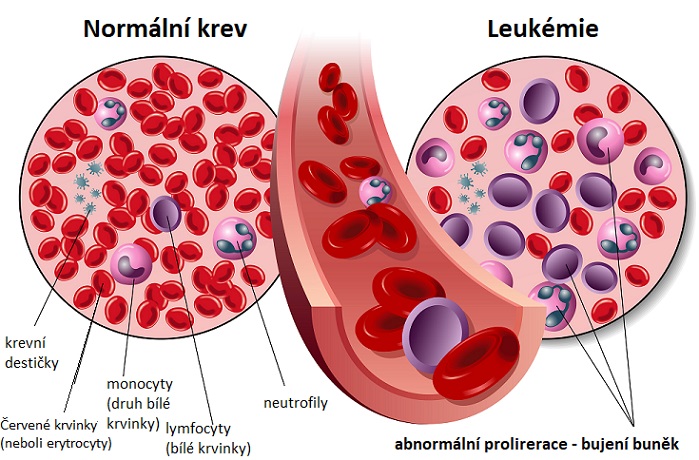 Leukémie - ilustrace
