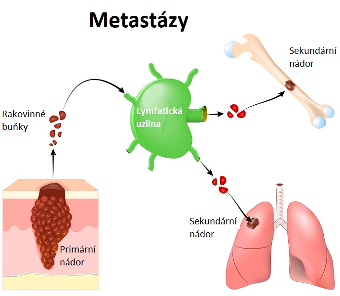 Metastázy - ilustrace