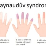 Raynaudův syndrom z vibrací: příznaky, příčiny a léčba
