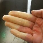 Raynaudova nemoc (Raynaudův syndrom) ovlivňuje vzhled i funkčnost prstů – příčiny, příznaky, léčba