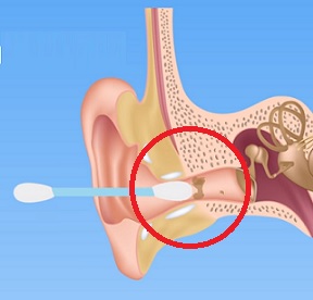 Zapomeňte při čištění uší na vatové tyčinky