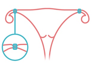 Základem ženské sterilizace je přerušení vejcovodů, vaječníky však zůstávají stejně funkční, jako byly dříve.