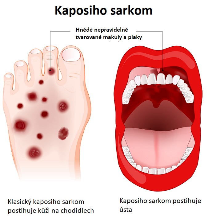 Kaposiho sarkom - ilustrace