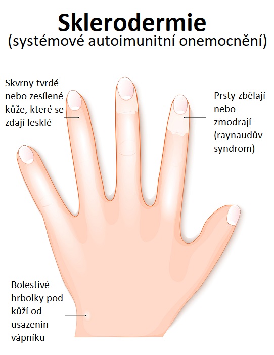 Sklerodermie - ilustrace