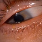 Syndrom suchého oka – příznaky, příčina a léčba