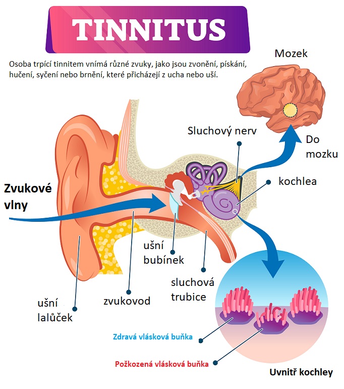 Tinnitus - ilustrace