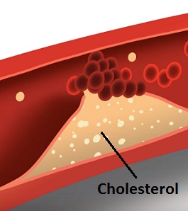 Když je cholesterolu mnoho, může vést k ateroskleróze, nebezpečnému ucpávání cév