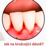 Krvácení dásní – jaké jsou příčiny a jak je vyřešit?