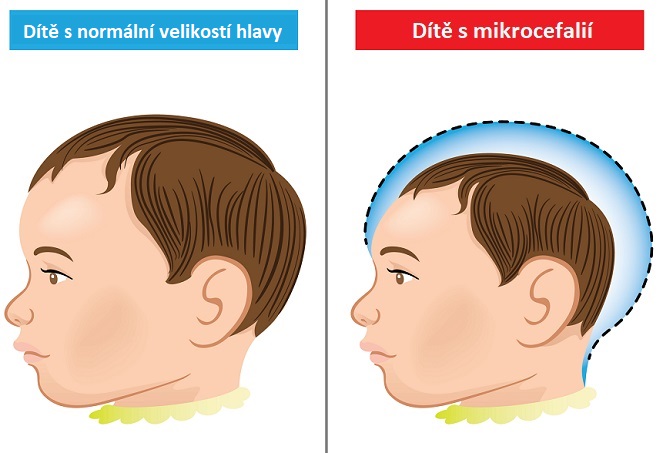 Mikrocefalie - ilustrace