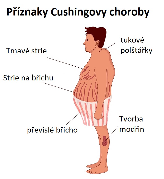 Příznaky Cushingova syndromu