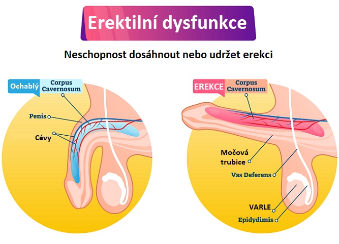 Erektilní dysfunkce - ilustrace