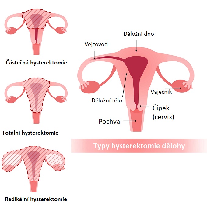 Hysterektomie dělohy je chirurgický zákrok, při kterém je odstraněna děloha ženy.