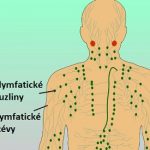 Non-Hodgkinův lymfom (NHL) – rakovina lymfatických uzlin – příznaky, léčba